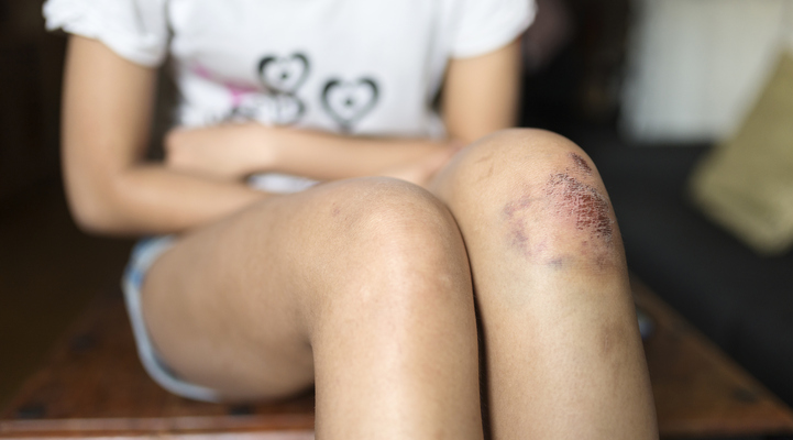 Barn med sår på knäna